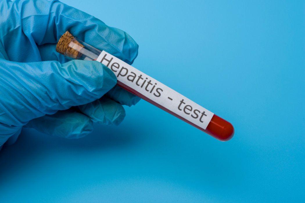 Dinkes Jatim Laporkan 114 Suspek Hepatitis Akut Misterius